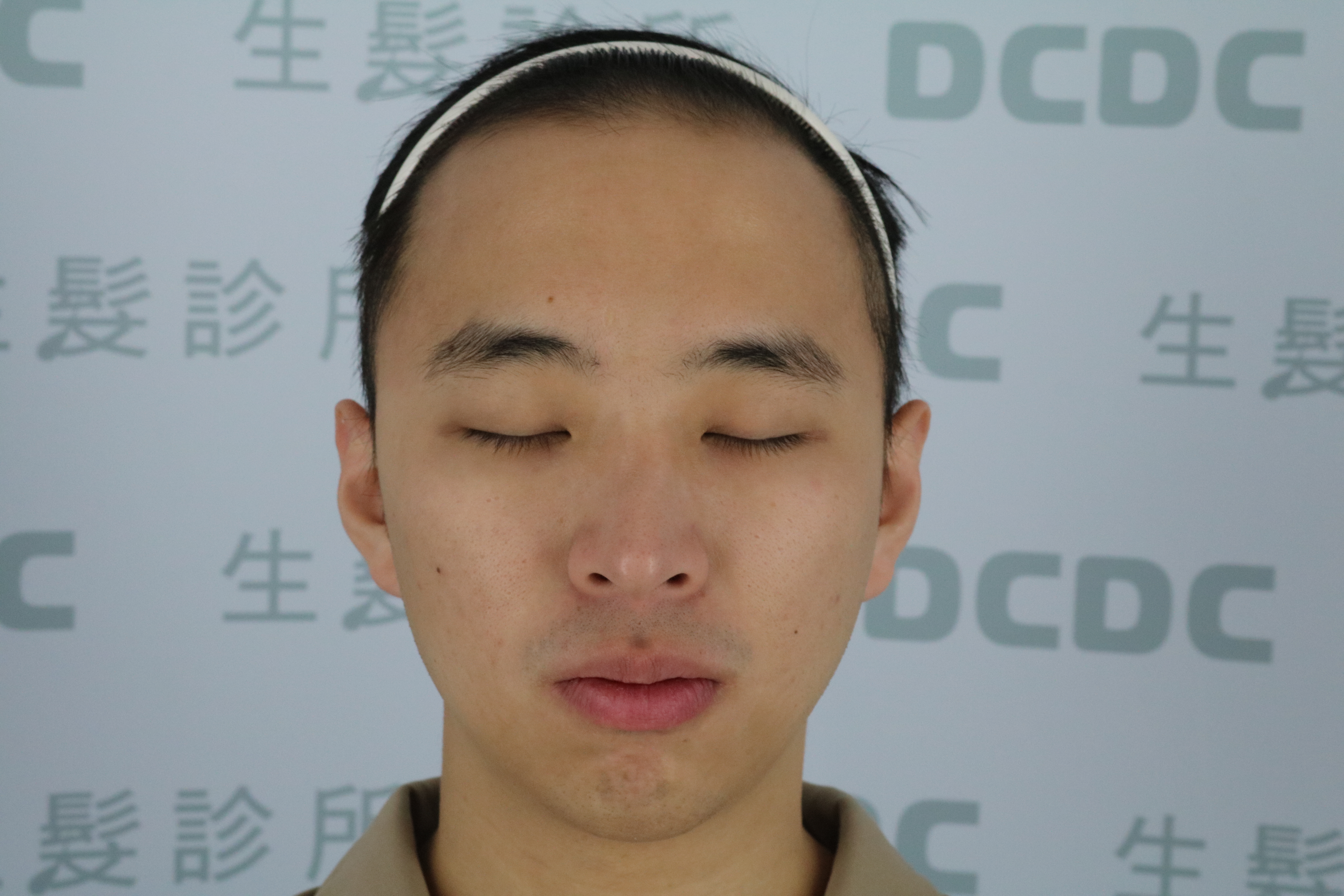 DCDC生髮診所-方孝俤醫師雄性禿評估M型額角後退與高額頭